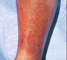 Cât de periculos dermatita varicos și dacă se poate vindeca de unul singur?