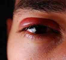Ce este un ochi inflamat rece?
