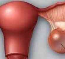 Chistadenomul de ovar - cauze, simptome, tratament