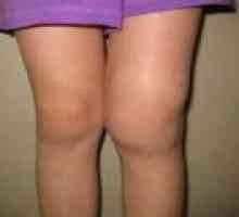 Deformând artroza articulației genunchiului