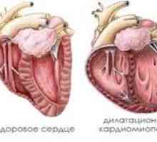 Cardiomiopatia dilatativă, cauze, simptome, tratament