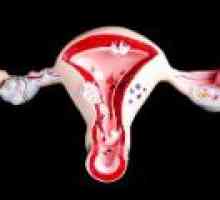 Sângerare uterină disfuncțională: cauze, tratament