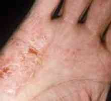 Disgidroticheskaya Eczeme - cauze, simptome, tratament