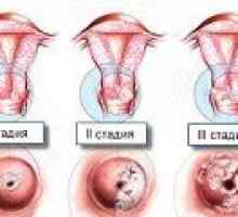 Displazia de col uterin - cauze, simptome, tratament
