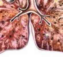 Diseminat tuberculoza: simptome, tratament