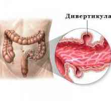 Intestin diverticuloza (colon) - simptome și tratament