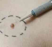 Avantajele și dezavantajele de tratamente de melanom