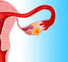 Fibrom ovarian