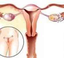 Foliculare chisturi ovariene, simptome și tratament