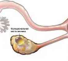 Chisturi ovariene funcționale - simptome, tratament