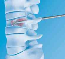 Hemangiomul spinării, ceea ce este și tratamente