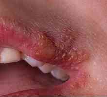 Herpes pe buze: cauze, prevenire, tratament