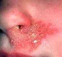 Răni la rece în nas, sub nas: cauze, tratament
