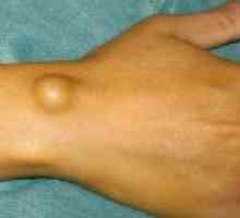 Higroma încheietura mâinii articulare: cauze si tratament