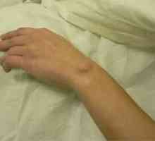 Încheieturi higroma, mâini, articulare - Higroma tratament