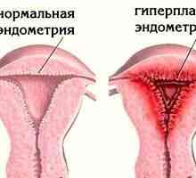 Hiperplazie uterin: simptome, tratamentul hiperplaziei de col uterin
