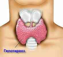 Hipotiroidism