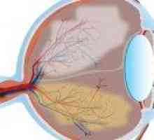 Glaucomul - Prevenirea și tratamentul glaucomului