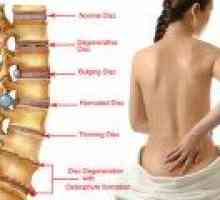 Sacrală coloanei vertebrale hernie: simptome, tratament