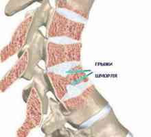 Hernia SHmorlja coloanei vertebrale lombare