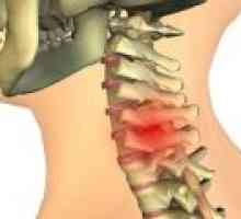 Chondrosis coloanei vertebrale cervicale: cauze, tratament