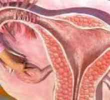 Cancer endometrial cronica - cauze, simptome, tratament