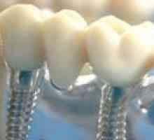 Implanturile dentare: fapte cheie