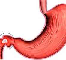 Ulcer duodenal și posibilele sale simptome