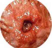 Ulcer gastric