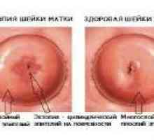Ectropion de col uterin, simptome, tratament