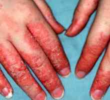 Eczeme pe mâini: vindecarea, medicamente, comentarii