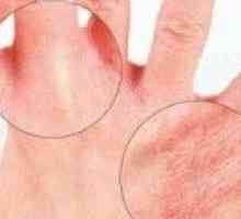 Eczema (pe mâini, picioare) cauze, simptome și tratament
