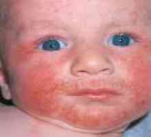 Eczema copilului: simptome, tratament