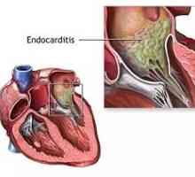 Endocardită