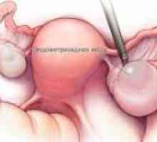 Chist ovarian endometrioide - cauze, simptome, tratament