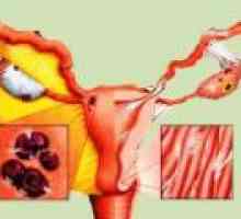 Endometrioza: simptome, semne, tratament