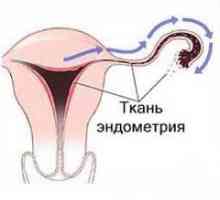 Endometrita