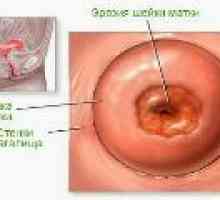 Eroziune cervicală în nulipare - cauze si tratament