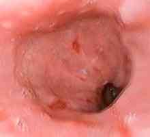 Eroziune a esofagului