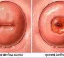 Eroziune de col uterin si sarcina