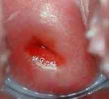 Simptome de eroziune de col uterin