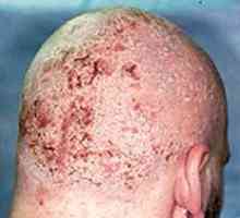 Cum să se ocupe cu dermatita seboreica? Tratamentul de remedii populare și medicale