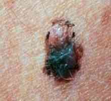 Cum de a recupera de melanom