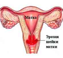 Cum de a trata eroziunea de col uterin