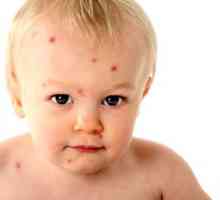 Cum face un varicelei la copii