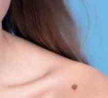 Cum de a identifica și de a vindeca pielea melanom
