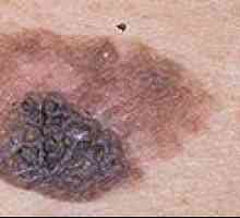 Cum de a determina prezența melanomului și vindecarea acesteia