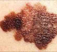 Cum de a determina melanomul de suprafață și pentru a preveni dezvoltarea sa