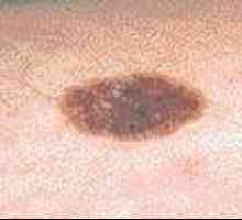 Cum este melanomul și sistemul Breslow Clark