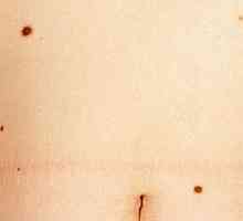 Cum este melanomul malign al trunchiului și cum să-l trateze